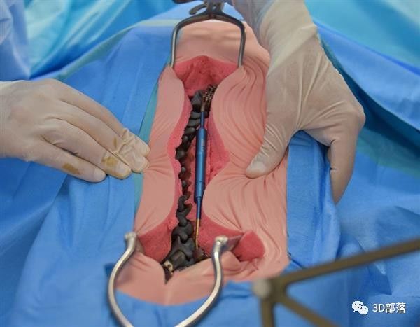 法国外科医生使用机器人和3D打印模型来修复6岁的脊椎在世界首例手术