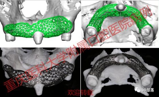 重医口腔医院成功实施全国首例3D打印个性化钛网修复大面积牙槽骨缺损