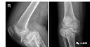 首例3D打印人工膝关节置换手术 为患者“私人订制”